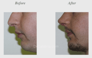 Chin Implants Before & After Photos