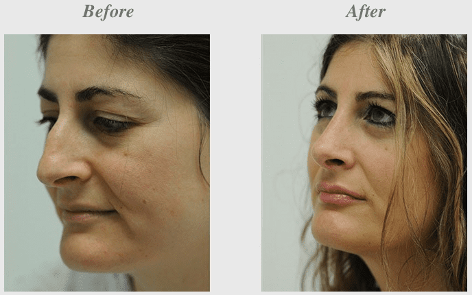 Rhinoplasty Before and After Photos