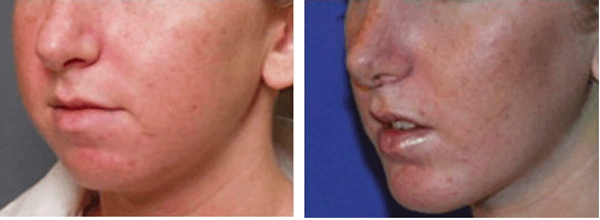 Chin-Before2 Implant Chin-After2