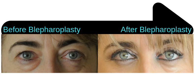 Blepharoplasty surgery, before and after