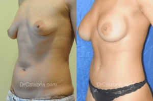Breast Augmentation Before and After Photos