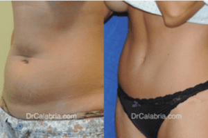 Tummy Tuck Before and After