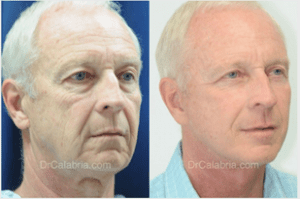 male facelift before and after photos by Dr. Calabria