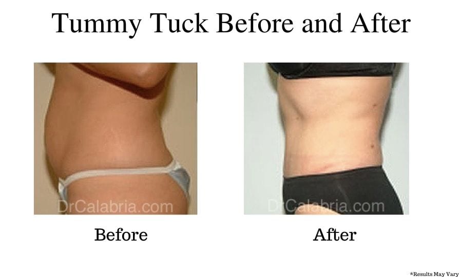 Mini Tummy Tuck vs. Full Tummy Tuck