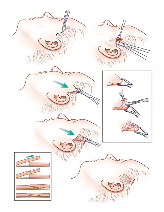 Diagram of One stitch Facelift