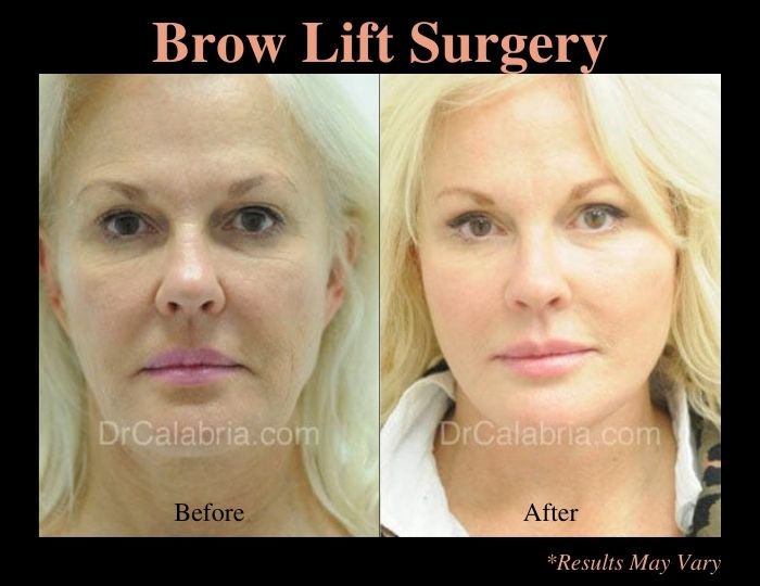 Before and after image of a brow lift performed in Beverly Hills, CA.