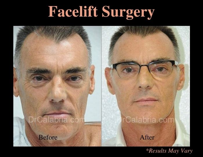 Before and after image showing the results of a male facelift performed in Beverly Hills, CA.