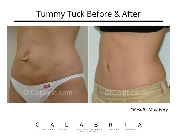 Before and after image showing the results of a tummy tuck on a woman after pregnancy in Beverly Hills.