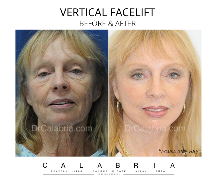 Before and after image showing the results of a facelift performed in Beverly Hills, CA.