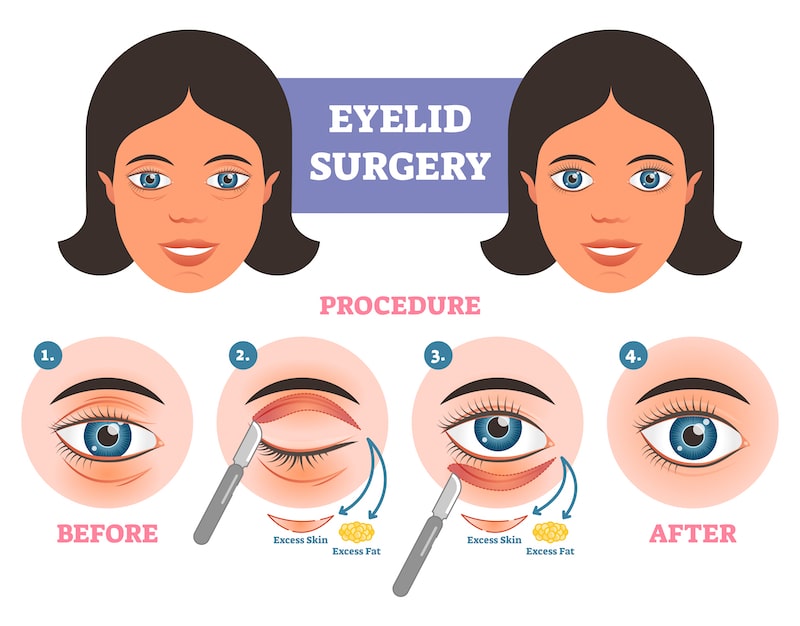 Illustration of how eyelid surgery is performed.