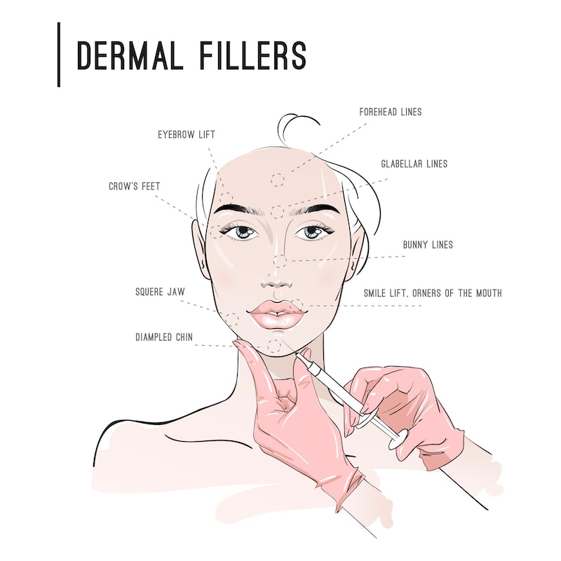 Illustration of how dermal fillers can address different areas of the face.