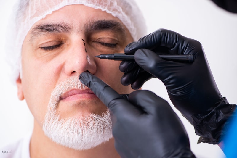 Senior man preparing for nose surgery while plastic surgeon draws surgical marks on the man's nose