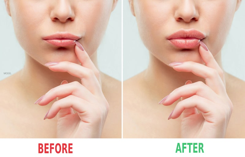 Before and after lip augmentation.